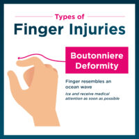 Example of boutonniere deformity finger injury