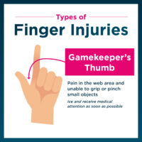 Example of gamekeeper's thumb finger injury