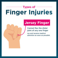Example of jersey finger injury