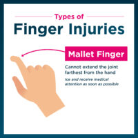 Example of mallet finger injury