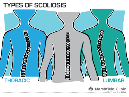 types of scoliosis