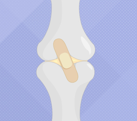 Bone and joint with a band aid over the top, illustration - Will torn cartilage heal?
