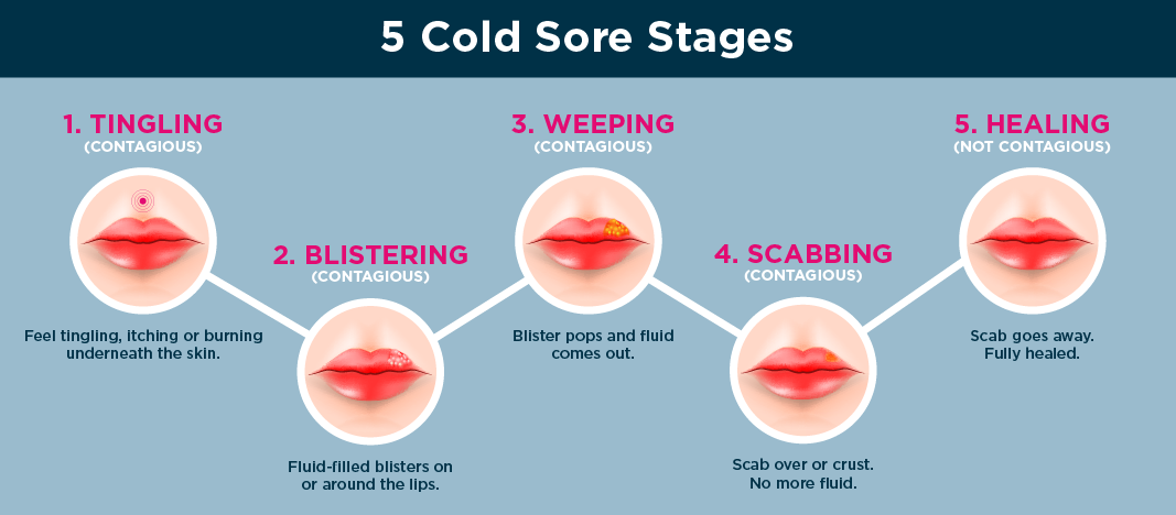 Graphic showing the 5 cold sore stages including tingling, blistering, weeping, scabbing and healing