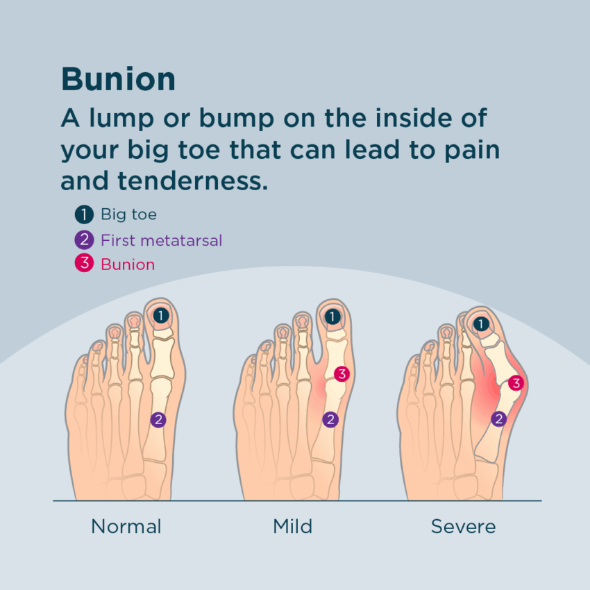 a bunion is a lump or bump on the inside of your big toe that can lead to pain and tenderness